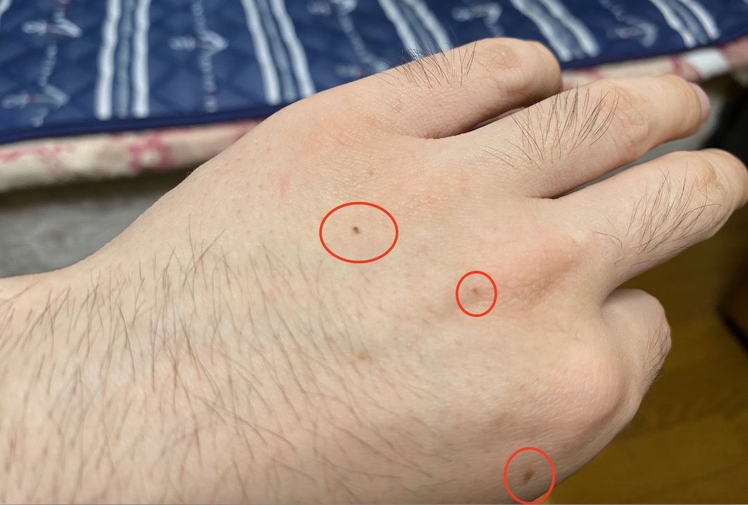 ホクロがあっても脱毛できる？